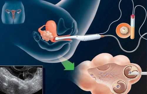 合法助孕试管机构选择指南与经验分享