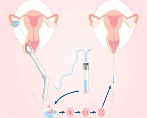 试管婴儿体质与智商解析:第二代技术是否影响孩子健康