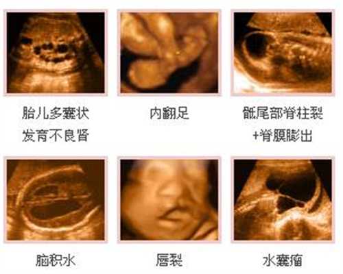 广州代孕需要多少费用_小孩流浓鼻涕最简单的清