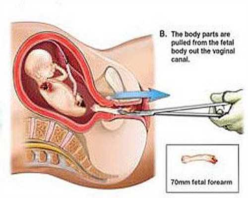广州代孕医院的流程_孕妈妈如何应对孕期腹泻