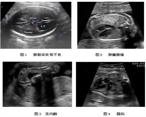 广州医院供卵-试管代孕需多少钱_50岁基础卵泡有多少个正常，能做试管婴儿吗