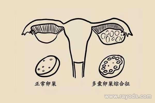 代孕助孕服务机构-广州北医三院供卵_为什么多囊患者会不孕？多囊卵巢综合征